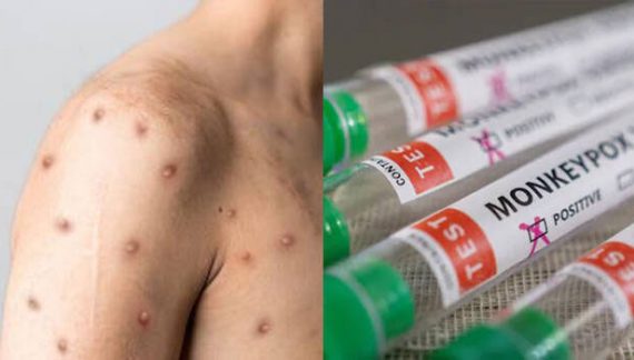 Health ministry releases dos and don’ts to prevent contracting monkeypox